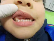 dacosta_kids_dentures_-_4-3_19
